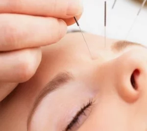 Cosmetic Acupuncture