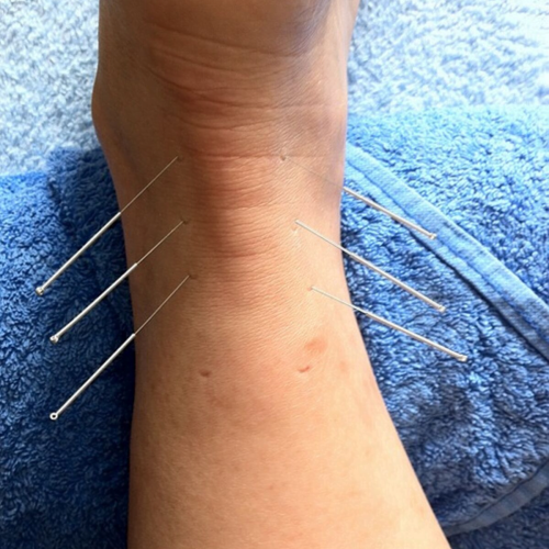 accelerated tendon healing Musculoskeletal and Sports Injury CPD (Including Acupuncture)