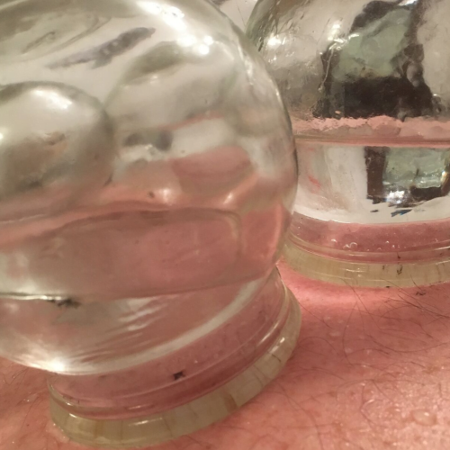 advanced fire cupping Advanced Fire Cupping